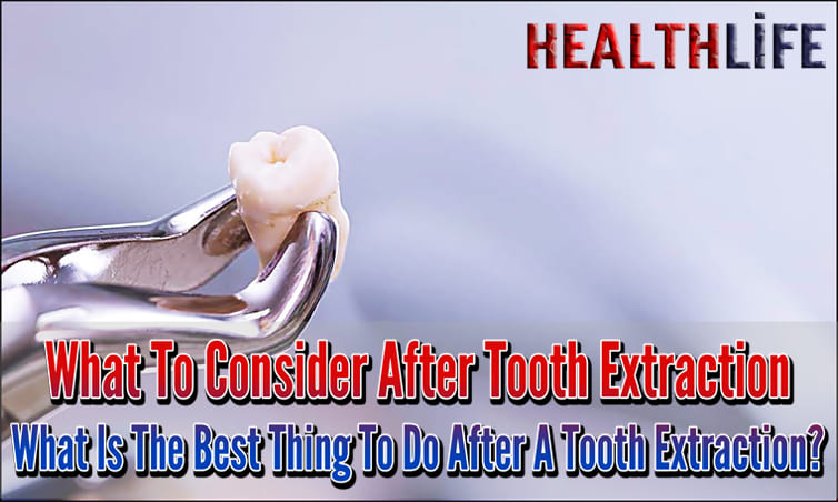 What To Consider After Tooth Extraction