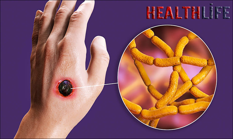 Which Is The Mode Of Transmission For Anthrax