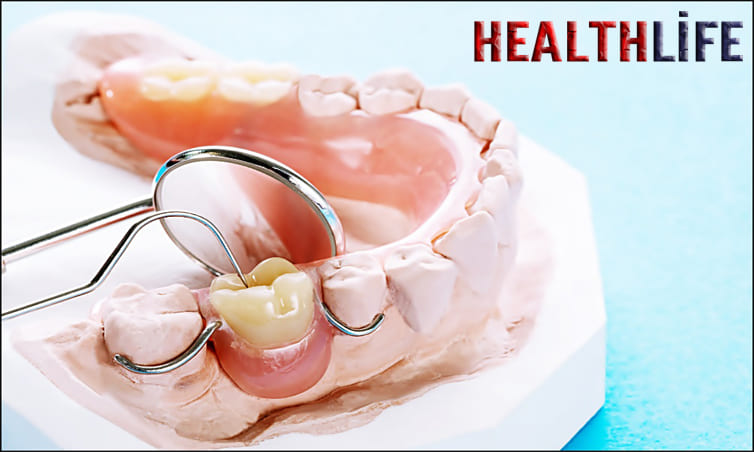Are Anchored Dentures The Same As Implants