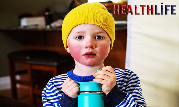 How Do I Know If My Baby Has Rosacea