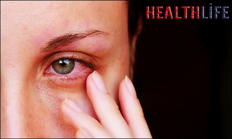 How Do You Get Rid Of Itchy Eyes