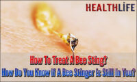 How To Treat A Bee Sting