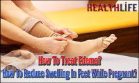 How To Treat Edema