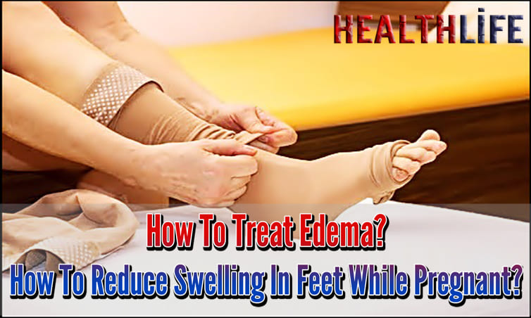 How To Treat Edema