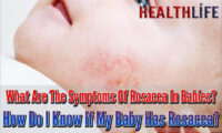 What Are The Symptoms Of Rosacea In Babies