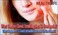 What Causes Cheek Swelling Due To Toothache