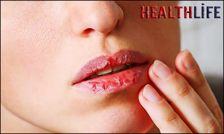 What Does It Mean When Your Lips Are Peeling