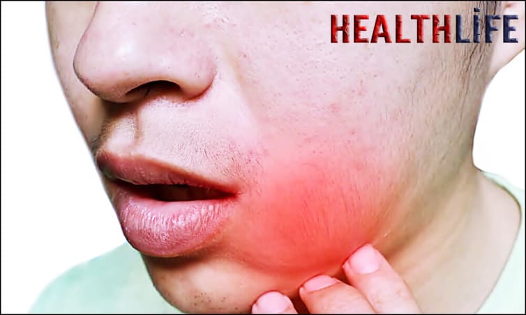 What Happens If A Tooth Infection Spreads To The Cheek