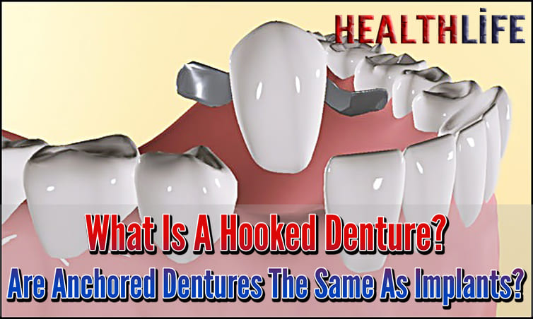 What Is A Hooked Denture