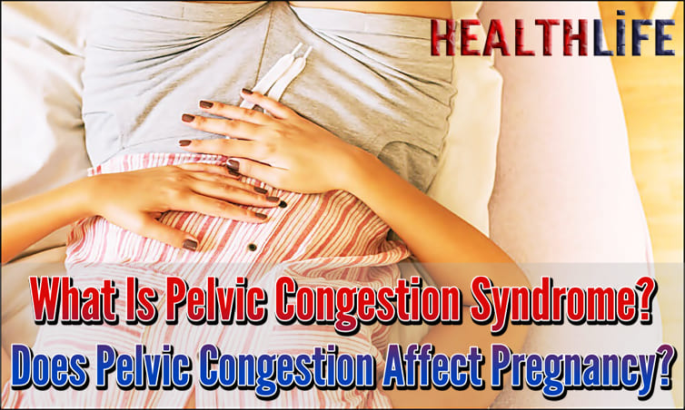 What Is Pelvic Congestion Syndrome