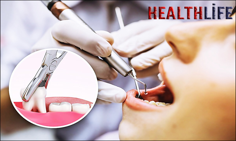 What Is The Best Advice After Tooth Extraction