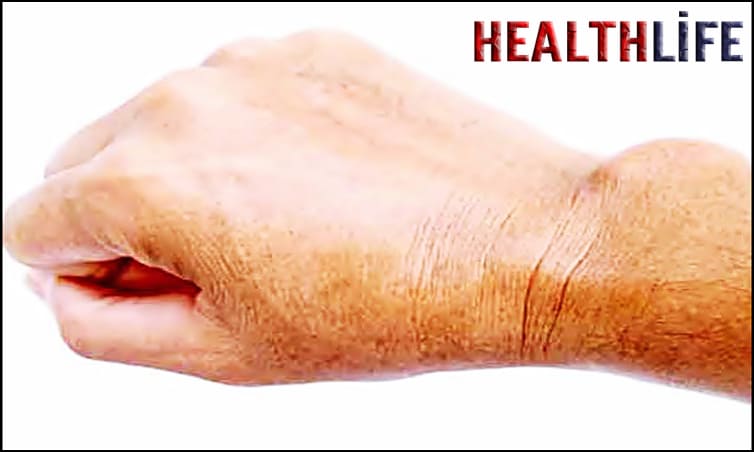 How Do You Get Rid Of Calcification In Your Body