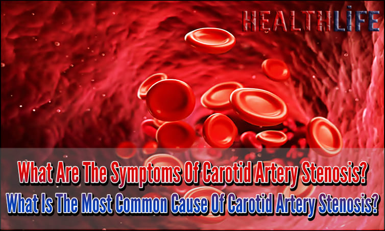 What Are The Symptoms Of Carotid Artery Stenosis