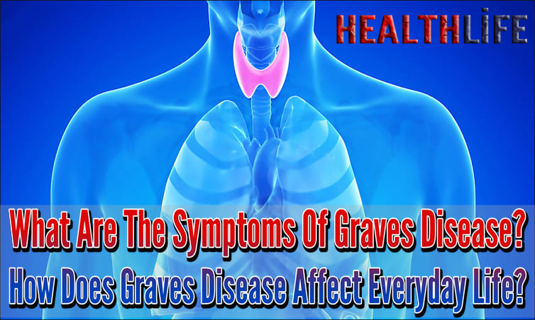 What Are The Symptoms Of Graves Disease