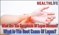 What Are The Symptoms Of Lupus Disease