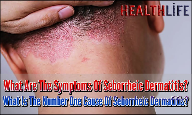 What Are The Symptoms Of Seborrheic Dermatitis
