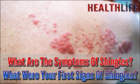 What Are The Symptoms Of Shingles