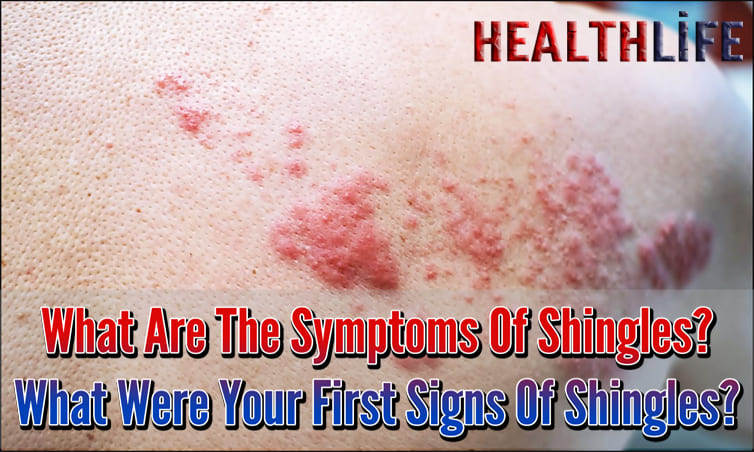 What Are The Symptoms Of Shingles