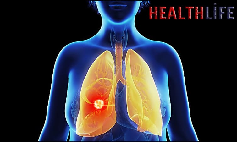 What Is The Average Age To Get Lung Cancer