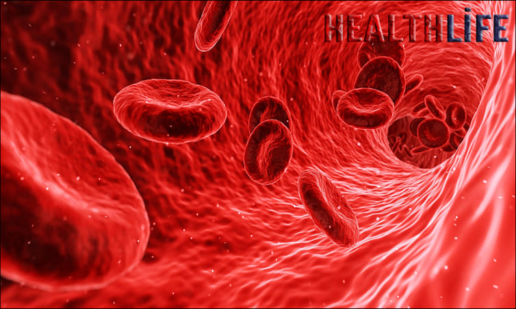 What Is The Most Common Cause Of Carotid Artery Stenosis