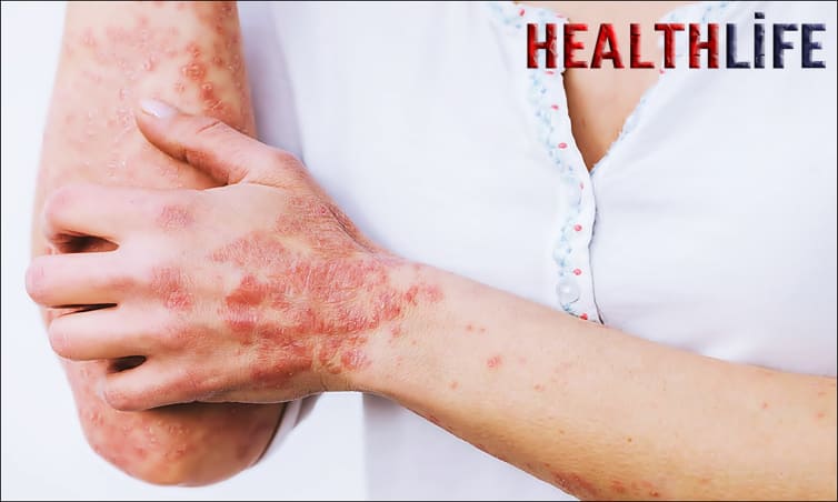 What Is The Number One Cause Of Seborrheic Dermatitis