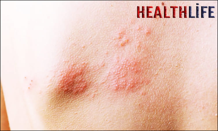 What Were Your First Signs Of Shingles