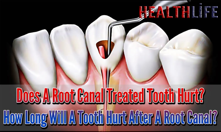 Does A Root Canal Treated Tooth Hurt
