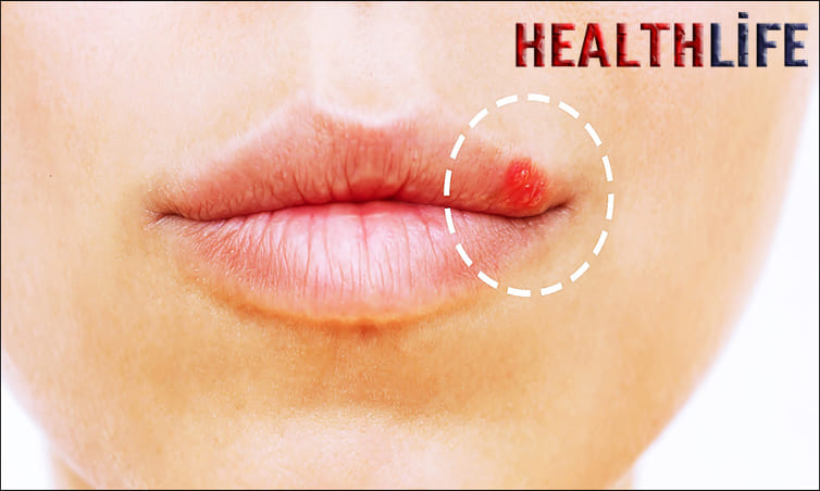 How Do People Deal With Herpes