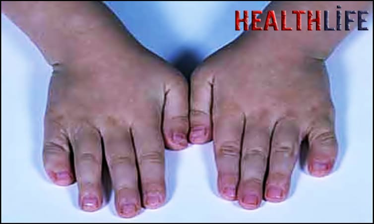 How Do You Diagnose Nager Syndrome