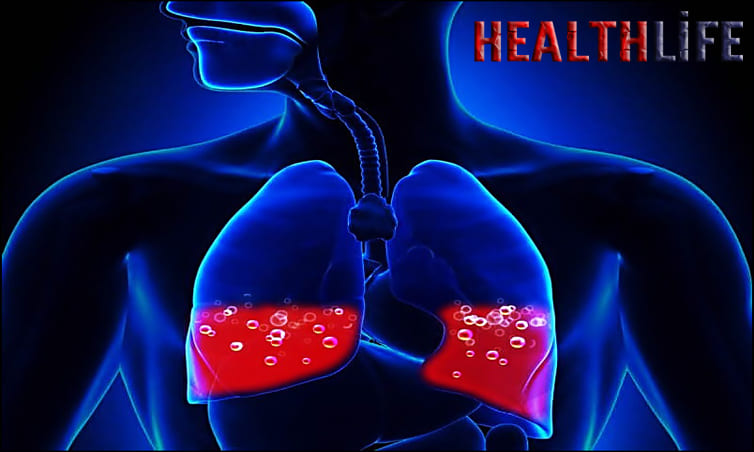 How Do You Get Rid Of Fluid Buildup In Your Lungs
