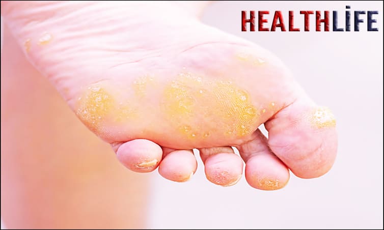 How Do You Permanently Get Rid Of Calluses