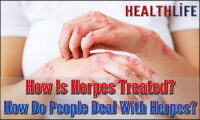 How Is Herpes Treated