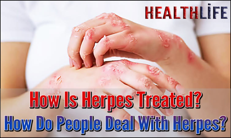 How Is Herpes Treated