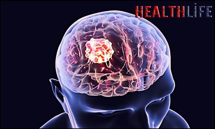 How Long Can You Have A Brain Tumor Without Knowing