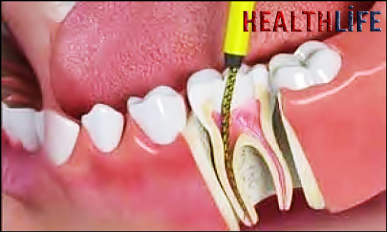 How Long Will A Tooth Hurt After A Root Canal