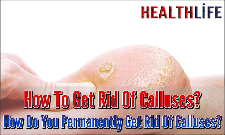 How To Get Rid Of Calluses