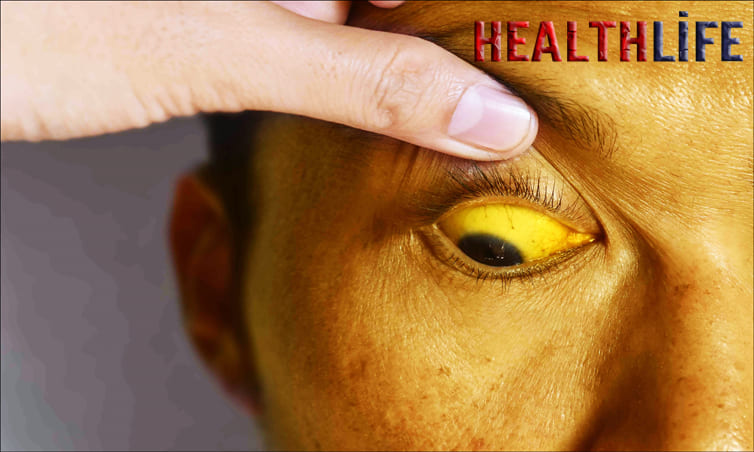 What Are The Four Main Symptoms Of Jaundice