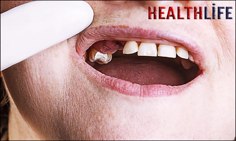 What Happens If You Dont Fix A Missing Tooth